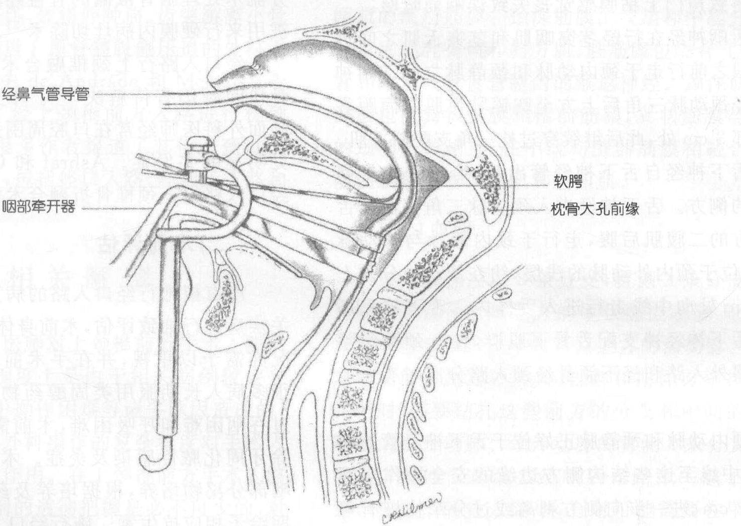 二、經(jīng)口腔手術(shù)入路